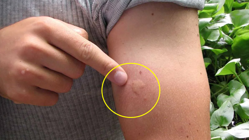  Surge in Infected Bug Bites: Expert Advice on Treatment and Prevention